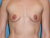 Patient # 51189 Before Photo # 1