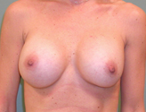 Patient # 51207 After Photo # 2