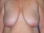Patient # 58790 Before Photo # 1