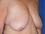 Patient # 58790 Before Photo # 3