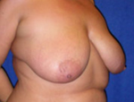Patient # 94817 Before Photo # 3