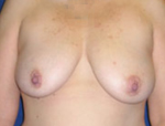 Patient # 67863 Before Photo # 1