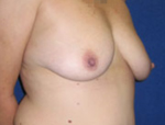 Patient # 67863 Before Photo # 3