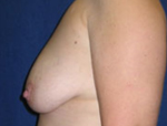 Patient # 67863 Before Photo # 5