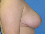 Patient # 32768 After Photo # 6