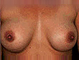 Patient # 93076 After Photo # 2