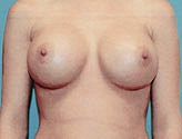 Patient # 65735 After Photo # 2