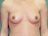 Patient # 65735 Before Photo # 1