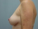 Patient # 88489 After Photo # 6