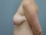 Patient # 88489 Before Photo # 5