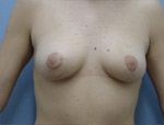 Patient # 92663 After Photo # 2