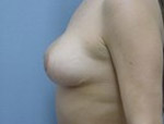 Patient # 92663 After Photo # 6