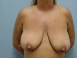 Patient # 52686 Before Photo # 1