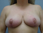 Patient # 58228 After Photo # 2