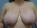 Patient # 58228 Before Photo # 1