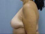 Patient # 88999 After Photo # 6