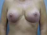 Patient # 11834 After Photo # 2