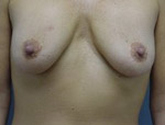 Patient # 11834 Before Photo # 1