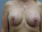 Patient # 18726 After Photo # 2