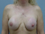 Patient # 18726 Before Photo # 1