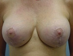 Patient # 92984 After Photo # 2