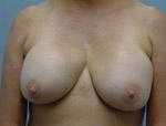 Patient # 92984 Before Photo # 1