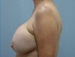 Patient # 92984 Before Photo # 5