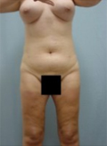 Patient # 70160 After Photo # 2