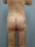 Patient # 70160 After Photo # 4