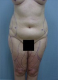 Patient # 70160 Before Photo # 1