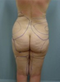 Patient # 70160 Before Photo # 3