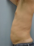 Patient # 15016 After Photo # 6