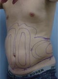 Patient # 15016 Before Photo # 3