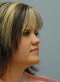 Patient # 98674 After Photo # 2