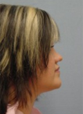 Patient # 98674 After Photo # 4