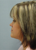 Patient # 98674 After Photo # 6