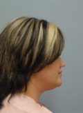 Patient # 98674 Before Photo # 3