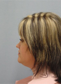 Patient # 98674 Before Photo # 5