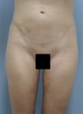 Patient # 57329 After Photo # 2
