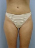 Patient # 57329 Before Photo # 1