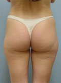 Patient # 57329 Before Photo # 3