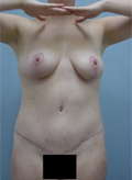 Patient # 87796 After Photo # 2