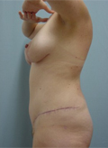 Patient # 87796 After Photo # 6