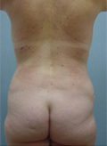 Patient # 87796 After Photo # 8