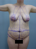 Patient # 87796 Before Photo # 1