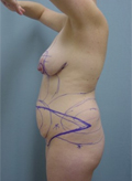 Patient # 87796 Before Photo # 5