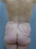 Patient # 87796 Before Photo # 7