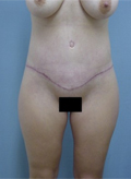 Patient # 61877 After Photo # 2