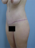 Patient # 61877 After Photo # 4