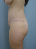 Patient # 61877 After Photo # 6